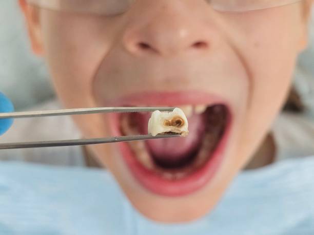 Best Emergency Dentist for Knocked-Out Tooth in Eatons Neck, NY